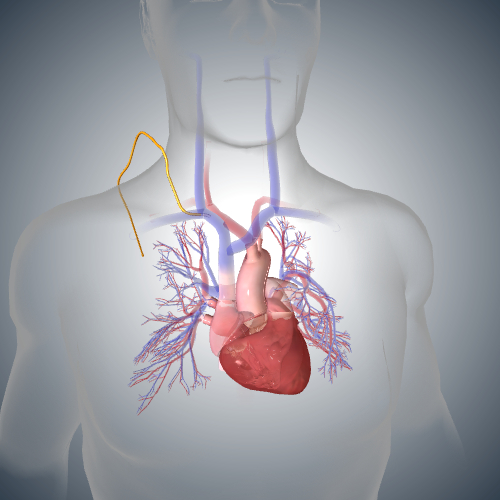 Cardiac Catheterization