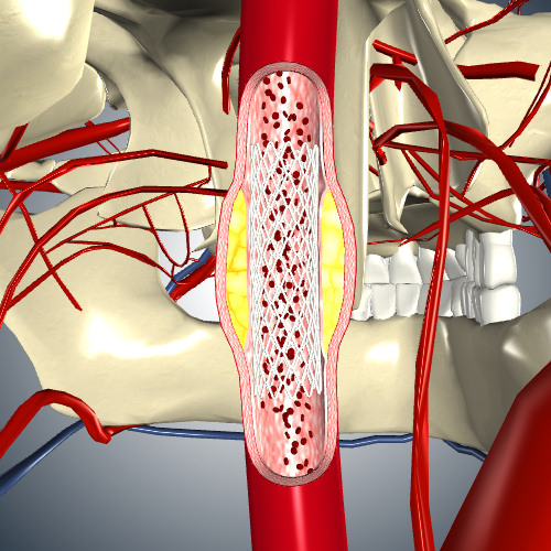 Carotid Stent