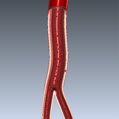 Peripheral Artery Disease