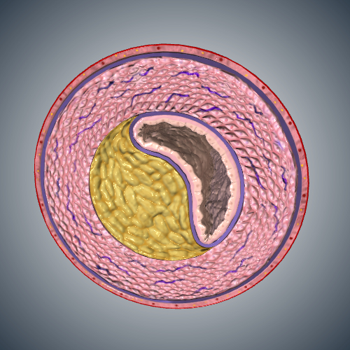 Progression of Atherosclerosis