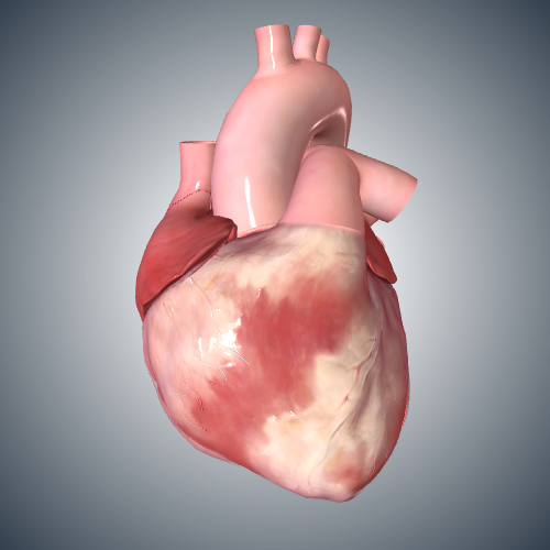 Ventricular Fibrillation Cardiac Cycle