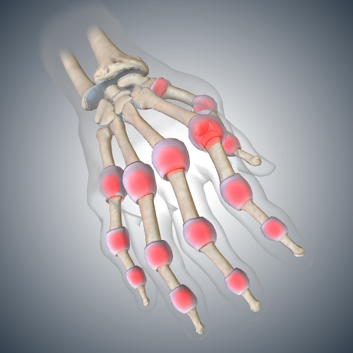 Advanced Rheumatoid Arthritis