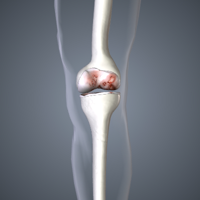 Arthritis - Knee