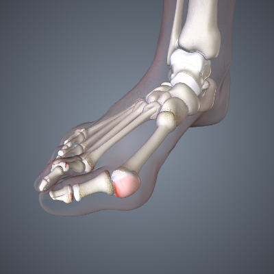 Arthritis of the Foot