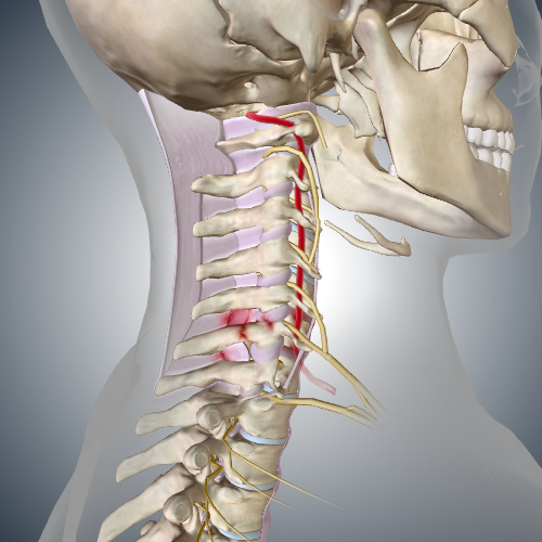 Cervical Burst Fracture