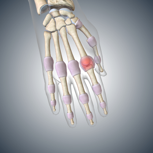 Early Rheumatoid Arthritis in Right 2nd Metacarpophalangeal Joint