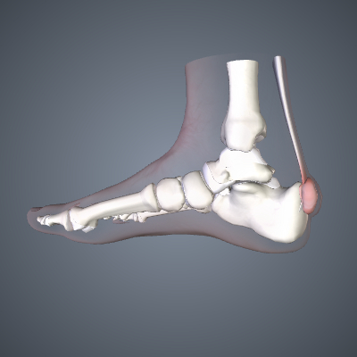 Haglund's Deformity