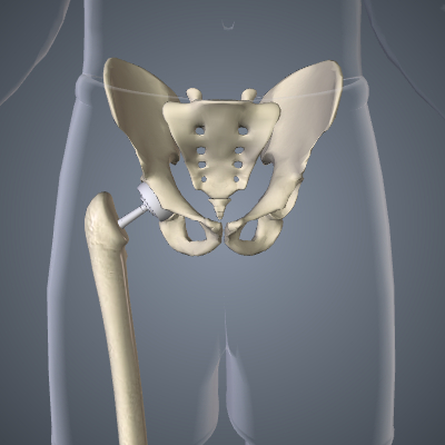 Hip Replacement