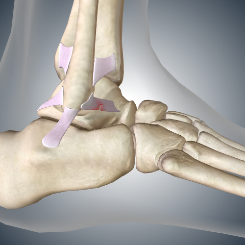 Lateral Ankle Sprain: Torn Anterior Talofibular Ligament