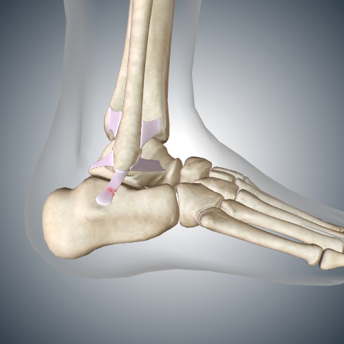 Lateral Ankle Sprain: Torn Calcaneofibular Ligment