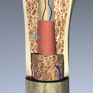 Myelofibrosis