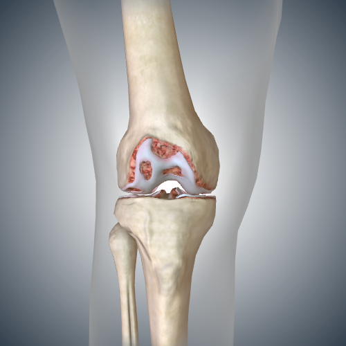 Osteoarthritis