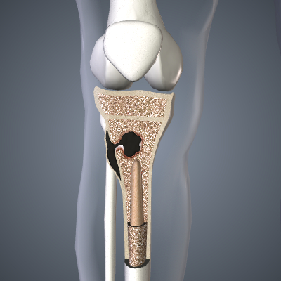 Osteomyelitis