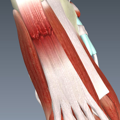 Plantar Fasciitis