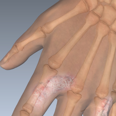 Psoriatic Arthritis