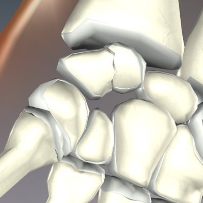 Scaphoid Wrist Fracture