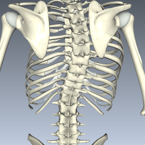 Scoliosis