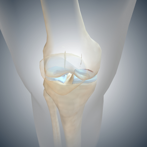 Torn Medial Meniscus