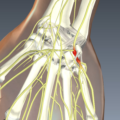 Ulnar Tunnel Syndrome