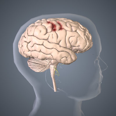 Hemorrhagic Stroke