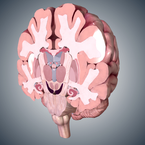 Multiple Sclerosis Lesions in Brain