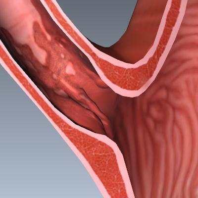 Barrett's Esophagus