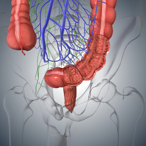 Colorectal Cancer: Stage III