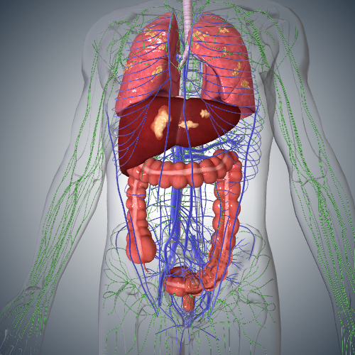 Colorectal Cancer: Stage IV