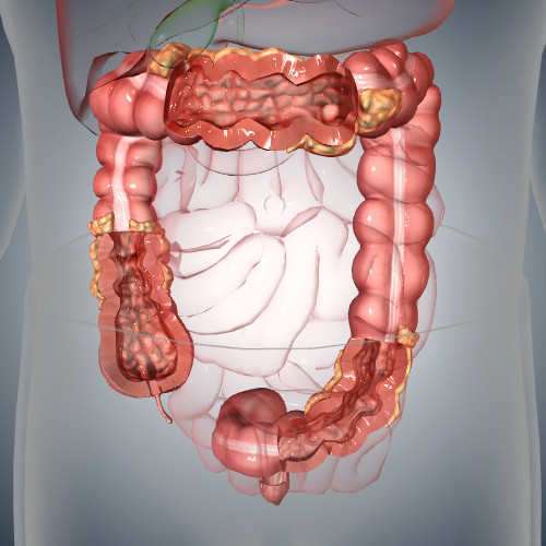 Crohn's Disease