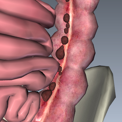 Diverticulosis and Diverticulitis