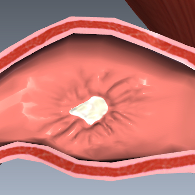 Duodenal Ulcer