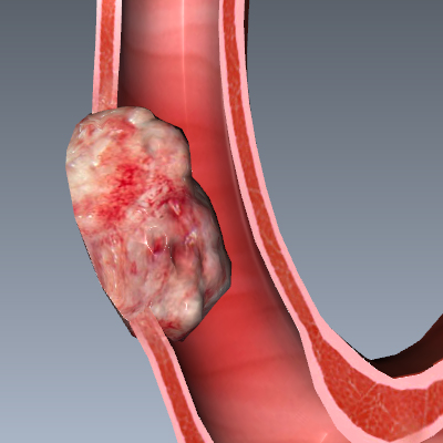 Esophageal Adenocarcinoma