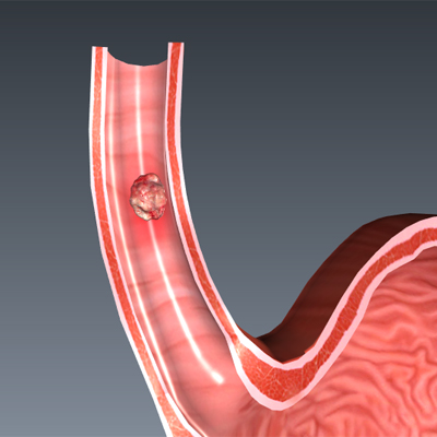 Esophageal Squamous Cell Carcinoma