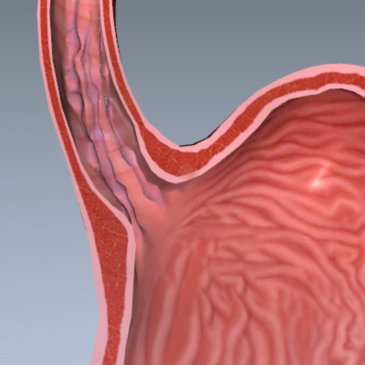 Esophageal Varices