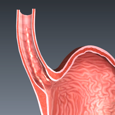 Esophagitis