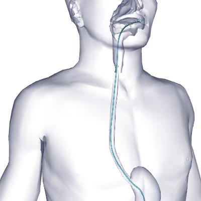 Esophagogastroduodenoscopy EGD