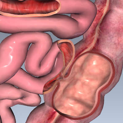 Fistula of the Intestines