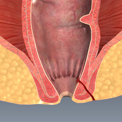 Fistula of the Rectum