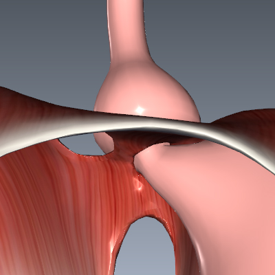 Hiatal Hernia