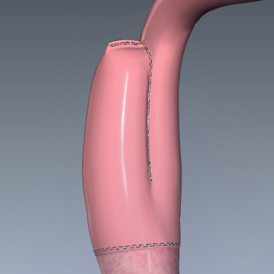 Ileoanal Anastomosis