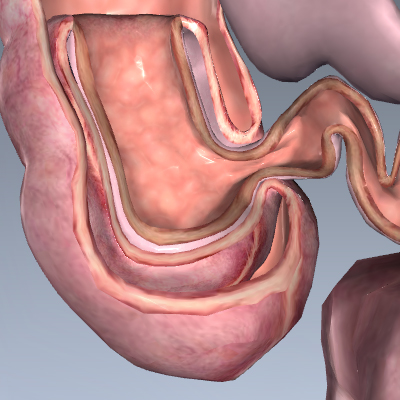 Intussusception