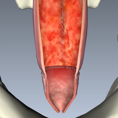 Pouchitis