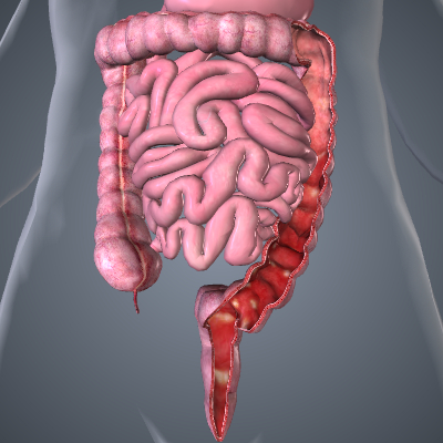 Ulcerative Colitis