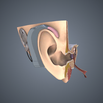 Cochlear Implant