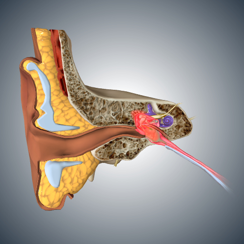 Middle Ear Infection