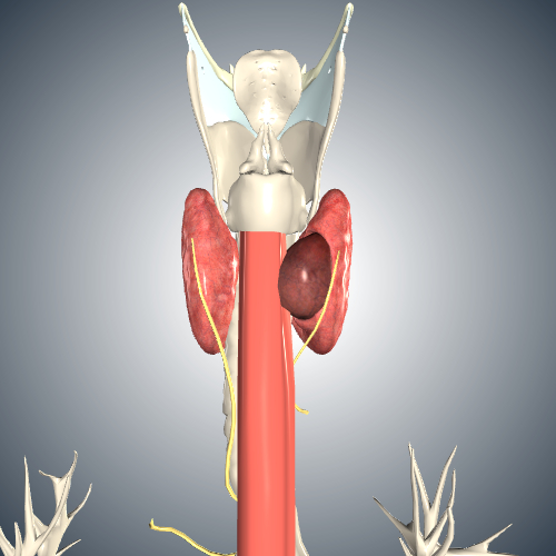 Thyroid Cancer Stage T4a - Esophageal Involvement