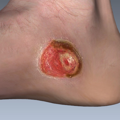 Diabetic Foot