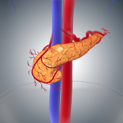 Pancreatic Cancer: Stage I