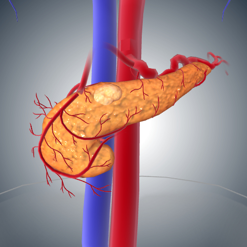 Pancreatic Cancer: Stage II