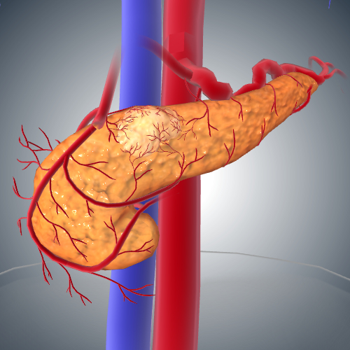 Pancreatic Cancer: Stage III